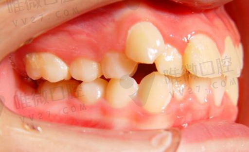 各种假牙基托厚度区别图,活动假牙基托(图1)